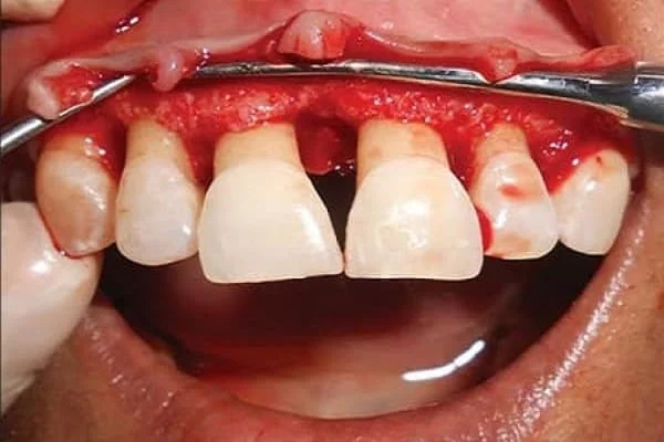Advanced Gum Surgery